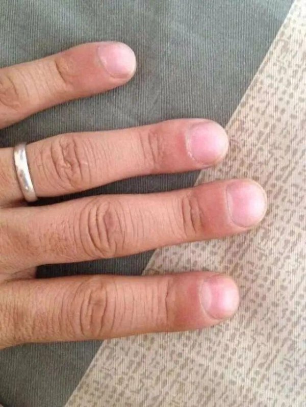 万德策略 出现“杵状指”，是肺癌的信号吗？有这种可能，但没那么简单